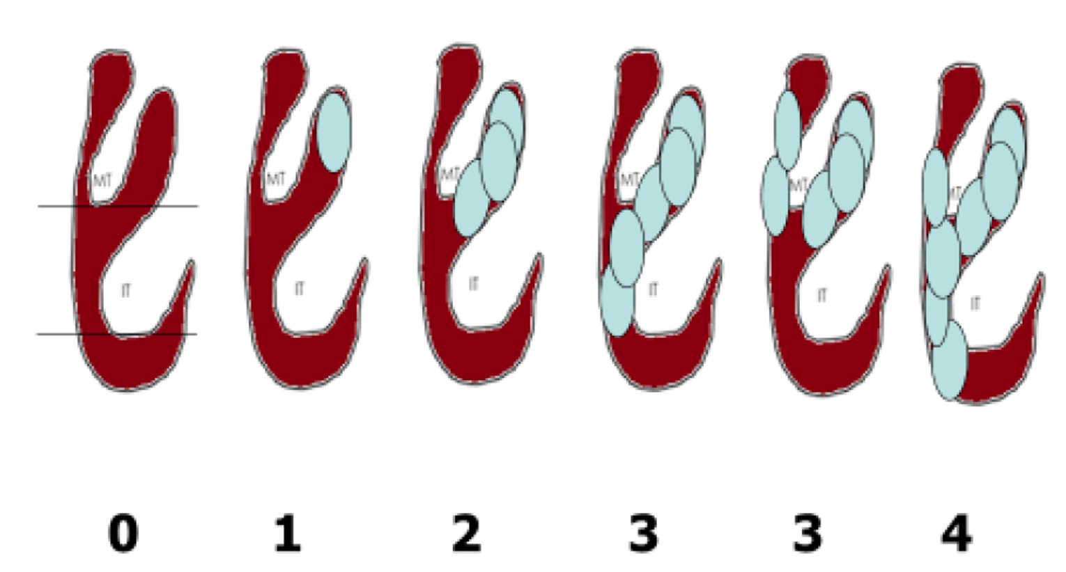 The figure shows 6 illustrations of a nasal passage, each with a different number of polyps in different positions (the first has no polyps). Under each illustration is the nasal polyp score: 0, 1, 2, 3, 3, 4. These scores are defined as follows: 0&nbsp;= no polyps; 1&nbsp;= small polyps in the middle meatus not reaching below the inferior border of the middle concha; 2&nbsp;= polyps reaching below the lower border of the middle turbinate; 3&nbsp;= large polyps reaching the lower border of the inferior turbinate or polyps medial to the middle concha; 4&nbsp;= large polyps causing complete congestion or obstruction of the inferior meatus.